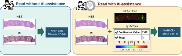 AI 驱动的肝纤维化评估取得突破：合作研究凸显对 MASH 诊断的变革性影响