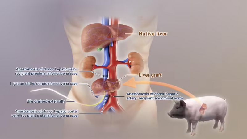 全球首例!中国团队成功将基因编辑猪肝脏移植到人体(图1) 全球首例!中国团队成功将基因编辑猪肝脏移植到人体(图1)