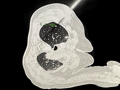 肺部穿刺导航机器人在沪投用,手术时间从半小时缩至10分钟 肺部穿刺导航机器人在沪投用,手术时间从半小时缩至10分钟(图1)